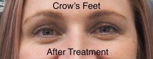 After Botox treatment for crow's feet.