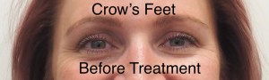Before Botox treatment for crow's feet.